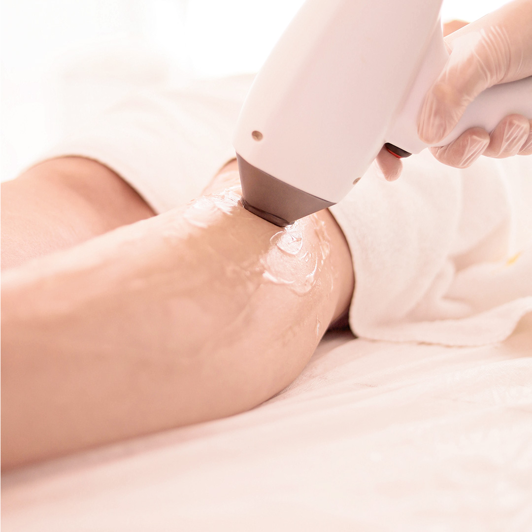 Depilación láser en Nápoles