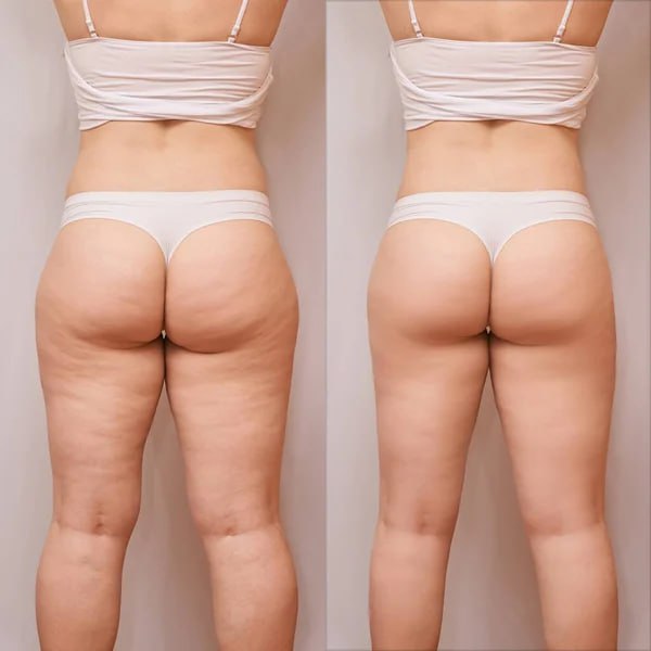 Tratamientos para reducción de celulitis