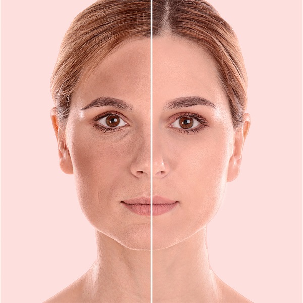 Tratamientos despigmentantes