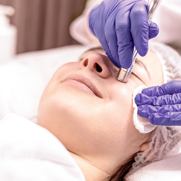 Microdermoabrasión para suavizar cicatrices y líneas finas